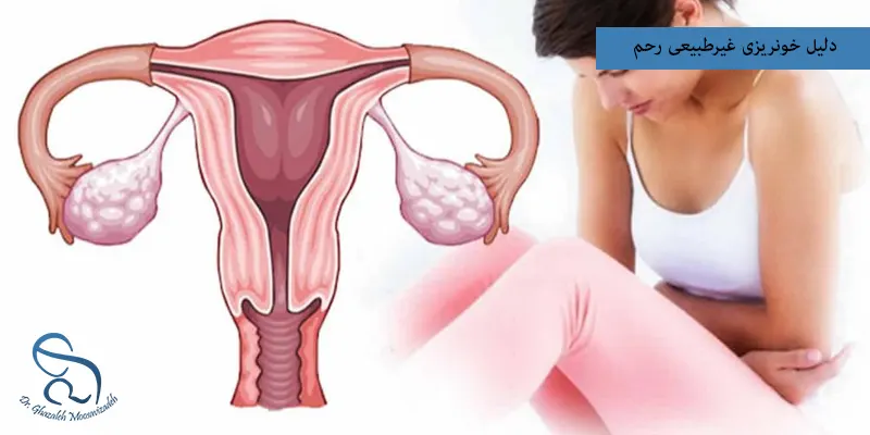 دلیل خونریزی غیرطبیعی رحم