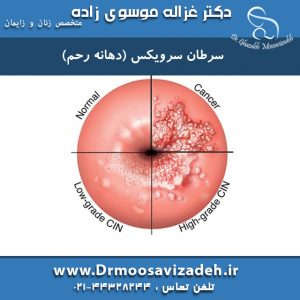 سرطان-سرویکس