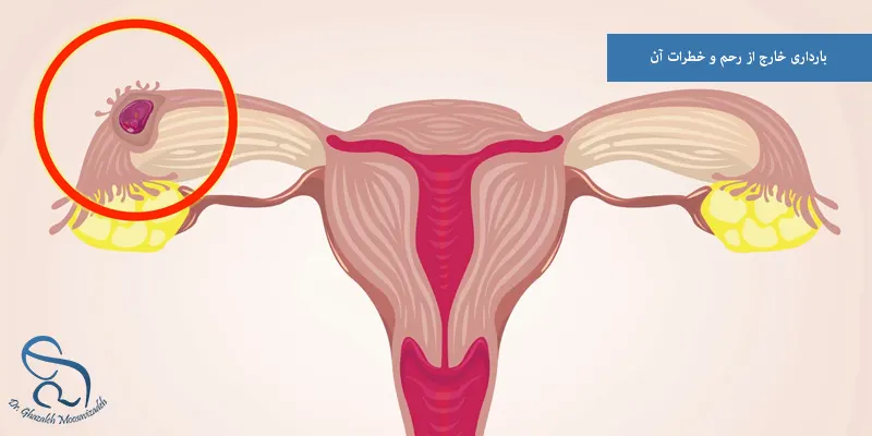 بارداری خارج از رحم و خطرات آن
