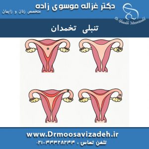 تنبلی-تخمدان