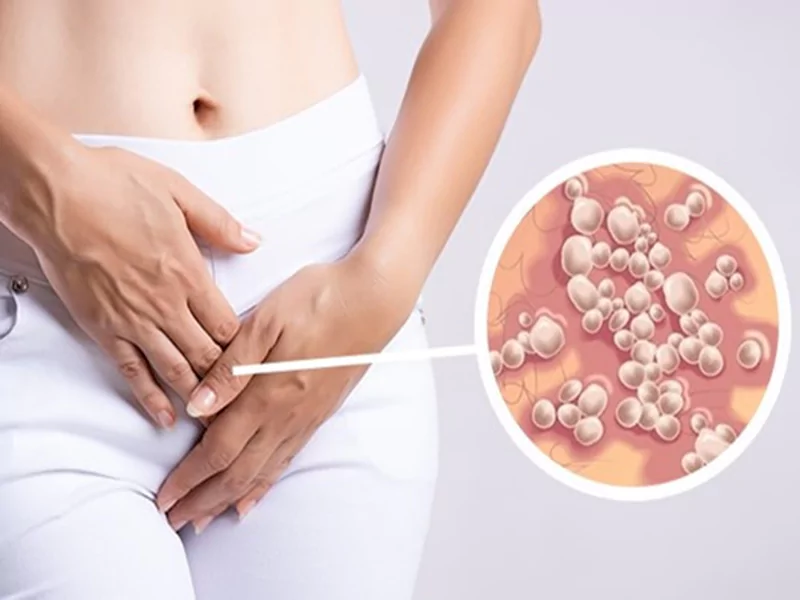 تبخال تناسلی و راه های پیشگیری از آن