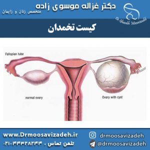 کیست تخمدان