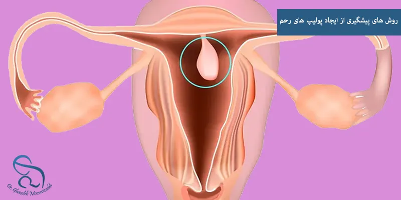 روش های پیشگیری از ایجاد پولیپ های رحم