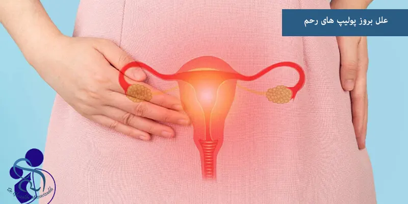 علل بروز پولیپ های رحم