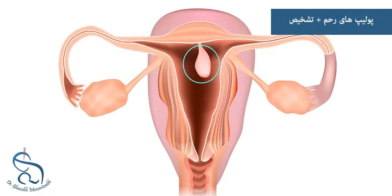 پولیپ های رحم + تشخیص