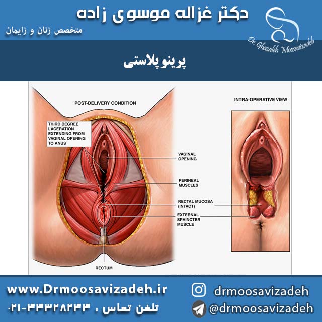 پرینو پلاستی