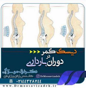 دیسک کمر در بارداری