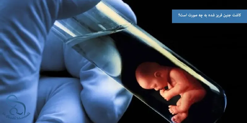 کاشت جنین فریز شده به چه صورت است؟