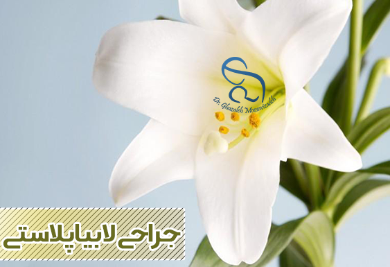 جراحی لابیاپلاستی