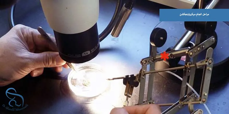 مراحل انجام میکرواینجکشن