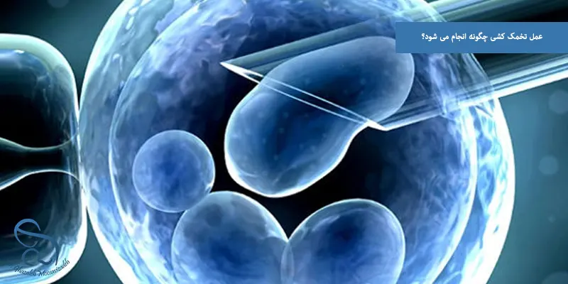 عمل تخمک کشی چگونه انجام می شود؟