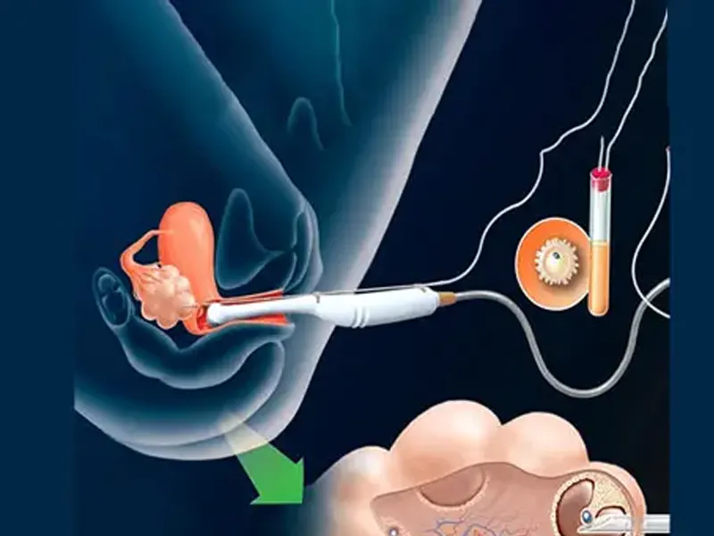 عمل تخمک کشی