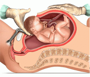 بهترین زایمان سزارین در تهران
